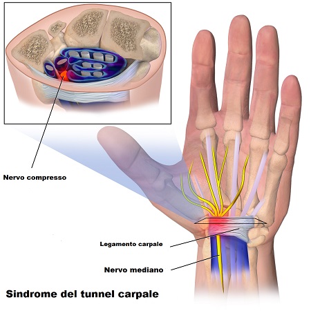 Sindrome da tunnel carpale