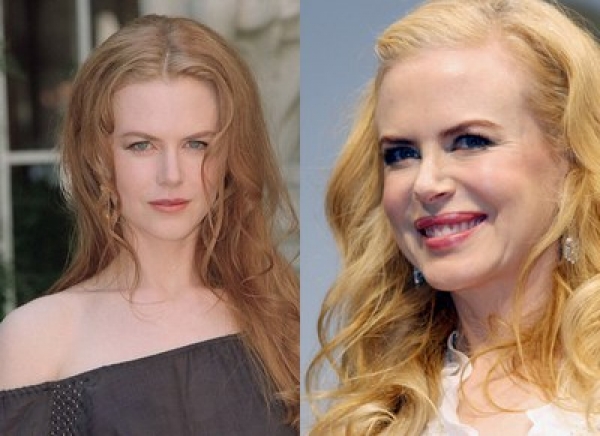 Una giovane Kidman (a sinistra) con i tratti del viso ancora non contratti dal botox