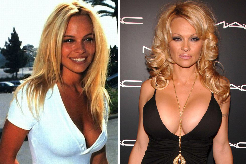 Pamela Anderson, emblema delle donne rifatte